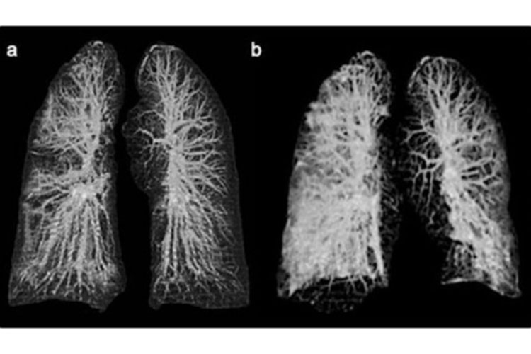 las_impactantes_imagenes_del_dano_que_provoca_el_coronavirus_a_los_pulmones.jpg